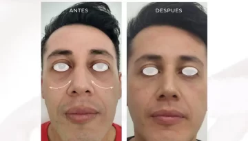 caso-clinico-bioestimulacion-aquashine-acidohialuronico