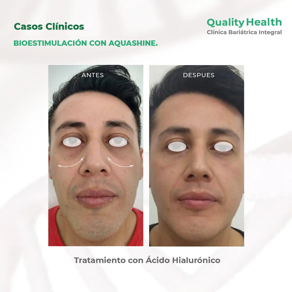 caso-clinico-bioestimulacion-aquashine-acidohialuronico
