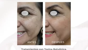 caso-clinico-bioestumilacion-con-aquashine-y-skincare-toxina-botulinica