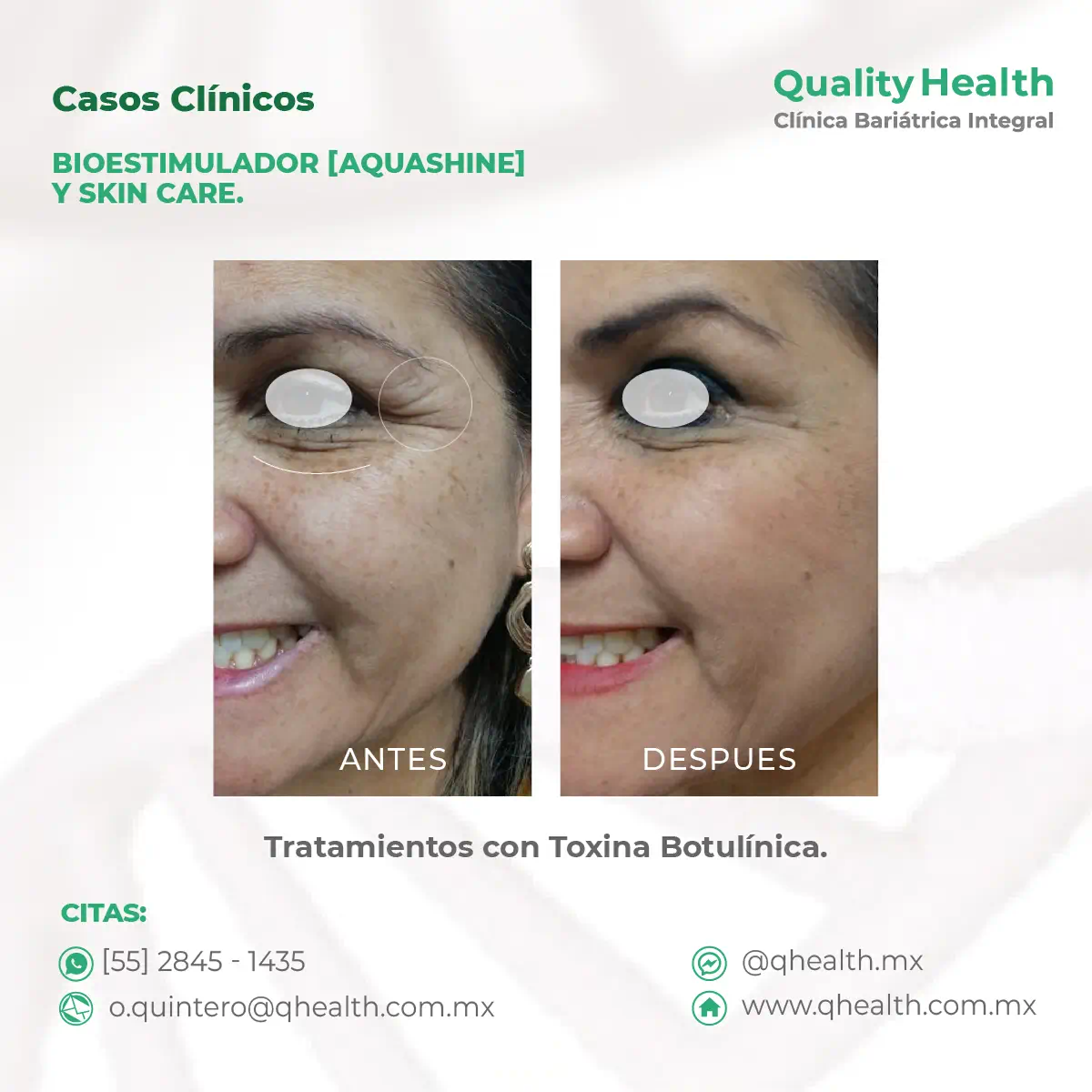 caso-clinico-bioestumilacion-con-aquashine-y-skincare-toxina-botulinica