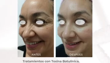 caso-clinico-contorno-de-ojos-y-dorso-nasal-toxina-botulinica