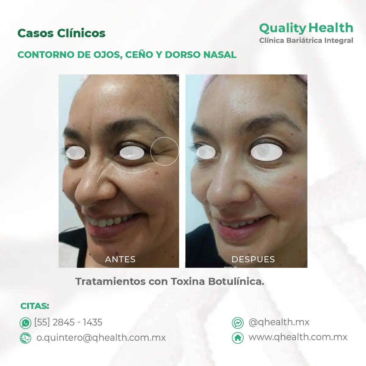 caso-clinico-contorno-de-ojos-y-dorso-nasal-toxina-botulinica