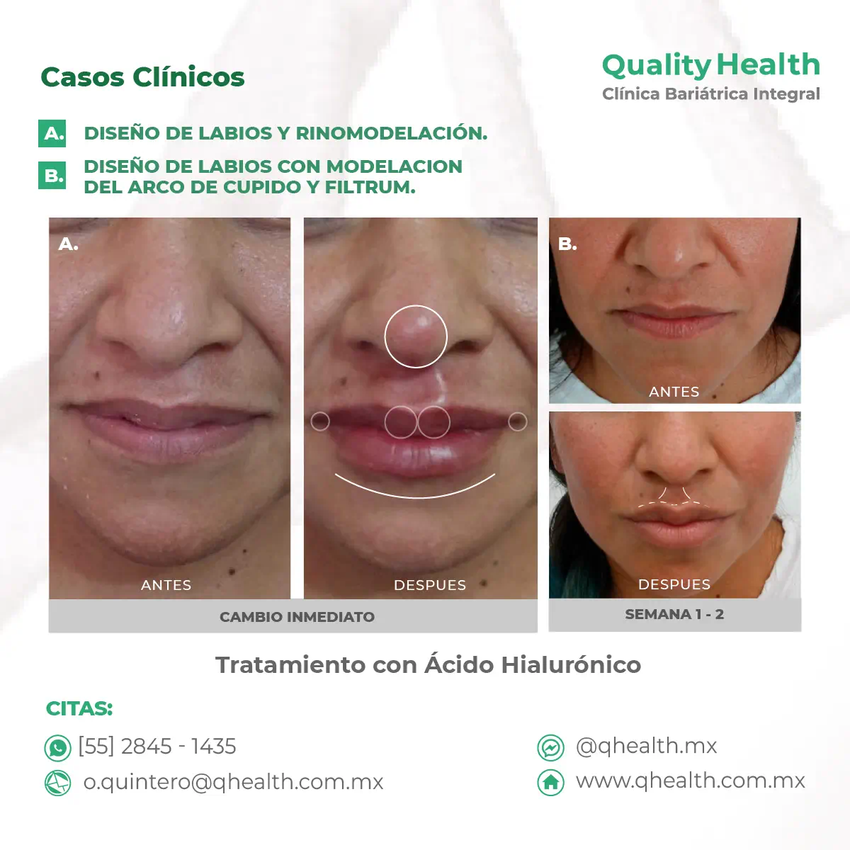 caso-clinico-diseño-de-labios-acidohialuronico-02