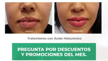 caso-clinico-diseño-de-labios-acidohialuronico