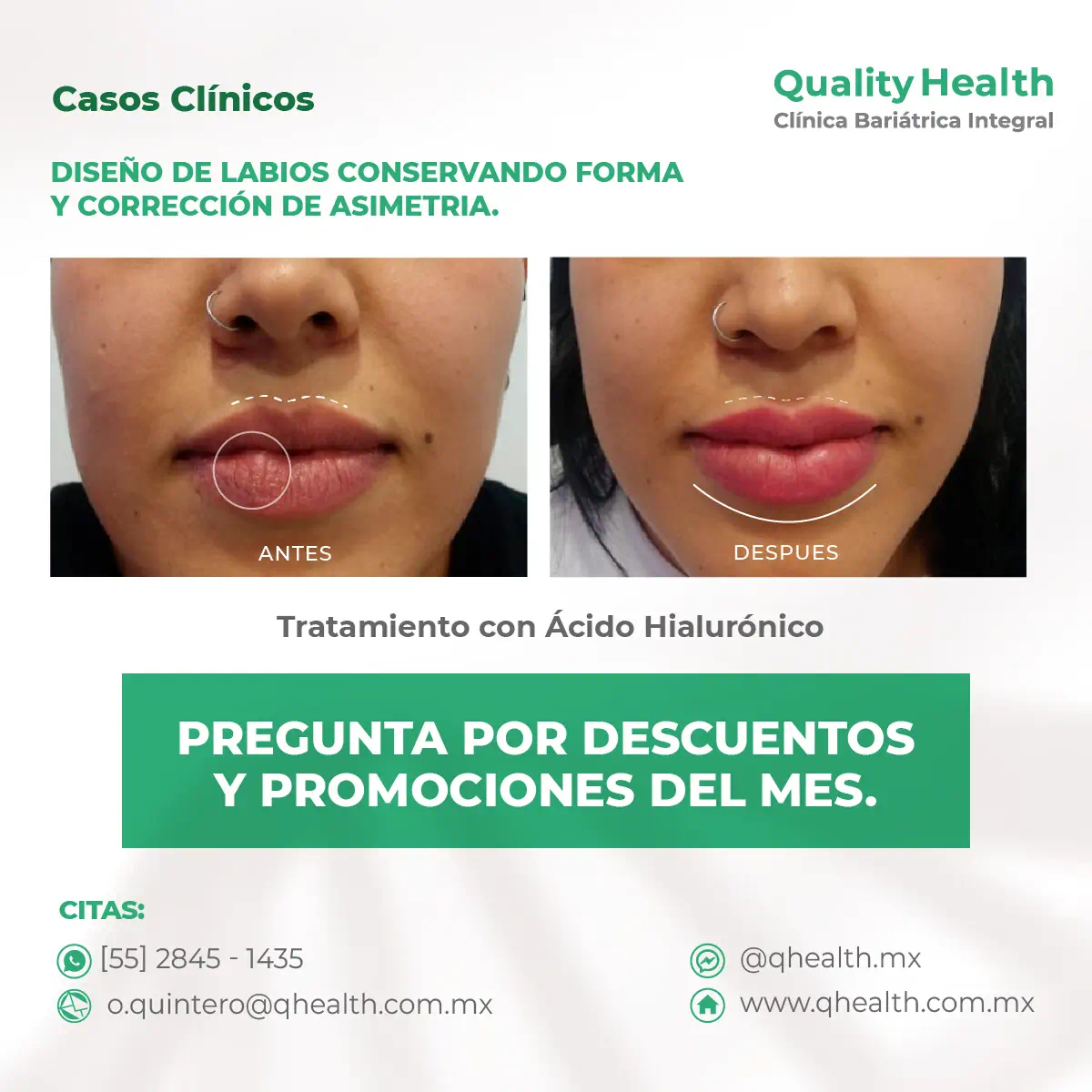 caso-clinico-diseño-de-labios-acidohialuronico