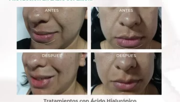 caso-clinico-diseño-labio-proyeccion-labio-superior-toxina-botulinica-acidohialuronico
