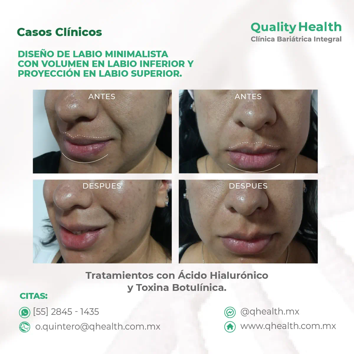 caso-clinico-diseño-labio-proyeccion-labio-superior-toxina-botulinica-acidohialuronico