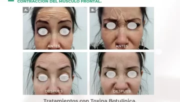 caso-clinico-lifting-ceja-correcion-asimetrica-toxina-botulinica