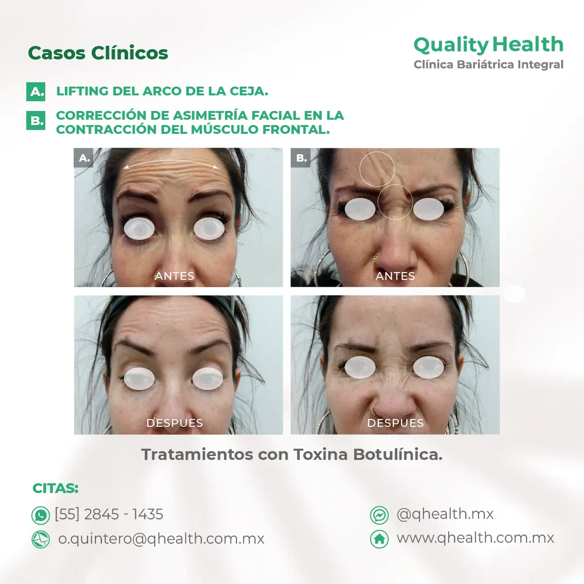 caso-clinico-lifting-ceja-correcion-asimetrica-toxina-botulinica