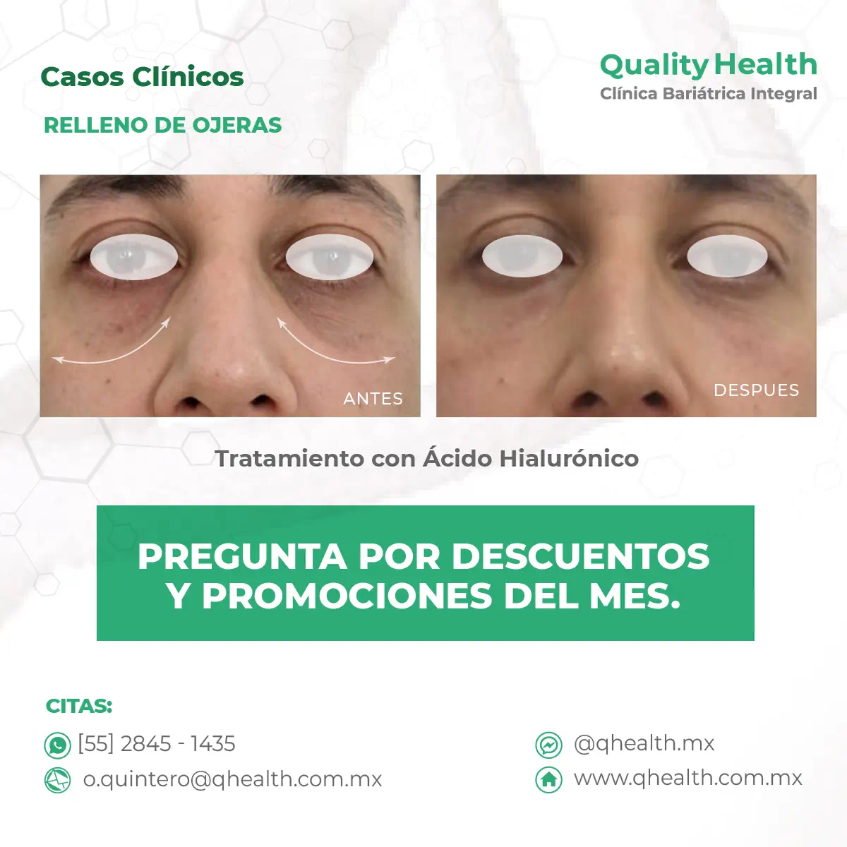 caso-clinico-relleno-de-ojeras-acidohialuronico