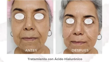 caso-clinico-relleno-de-surco-nasogenianoacido-hialuronico