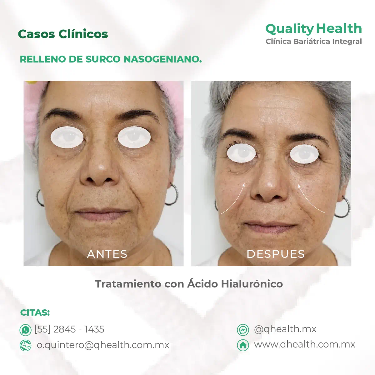 caso-clinico-relleno-de-surco-nasogenianoacido-hialuronico