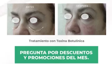 caso-clinico-relleno-ojera-correcion-de-bolsa-toxina-botulinica