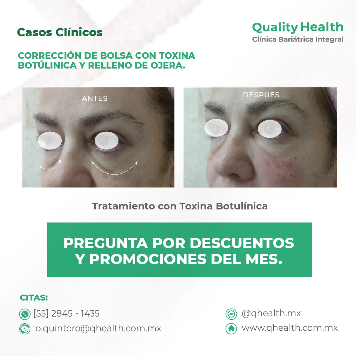 caso-clinico-relleno-ojera-correcion-de-bolsa-toxina-botulinica