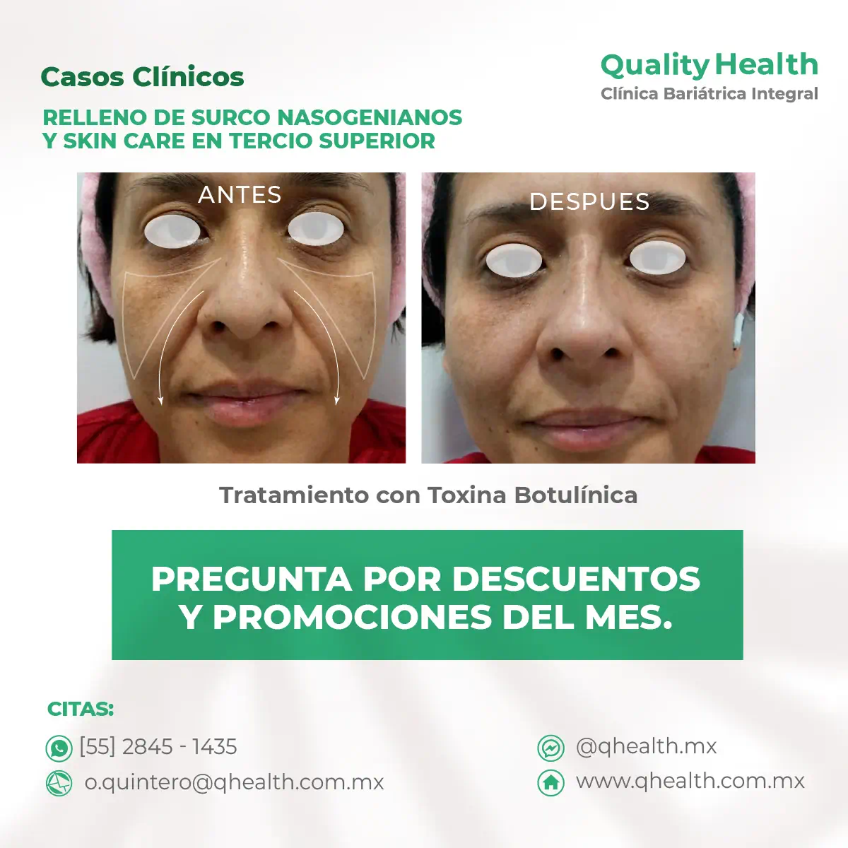 caso-clinico-relleno-surco-nasogeniano-y-tercio-superior-toxina-botulinica