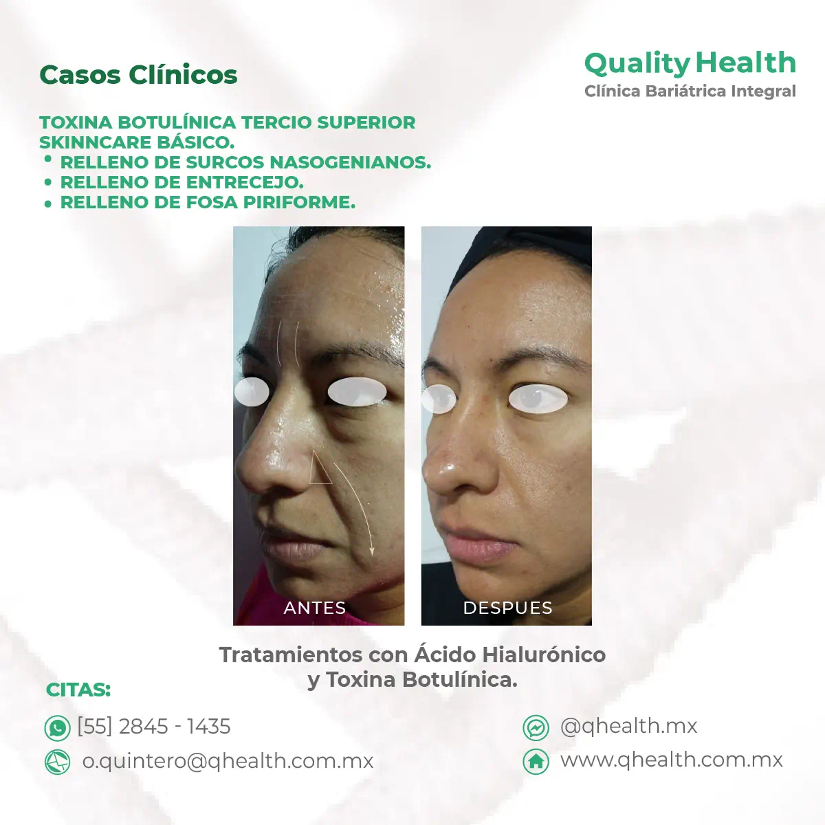 caso-clinico-relleno-surcos-nasogenianos-y-tercio-superior-toxina-botulinica-acidohialuronoico