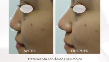 caso-clinico-rinomodelacion-acido-hialuronico