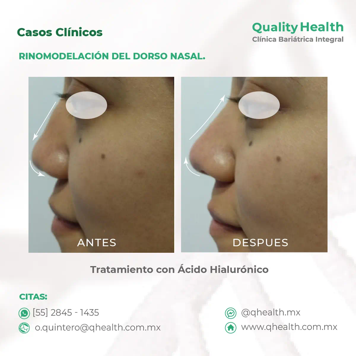 caso-clinico-rinomodelacion-acido-hialuronico