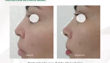 caso-clinico-rinomodelacion-acidohialuronico