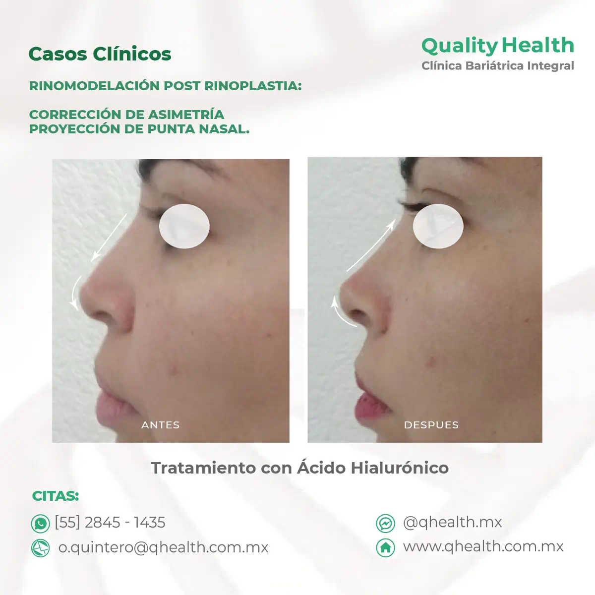 caso-clinico-rinomodelacion-acidohialuronico
