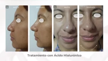 caso-clinico-rinomodelacion-y-poyeccion-de-menton-acido-hialuronico-02