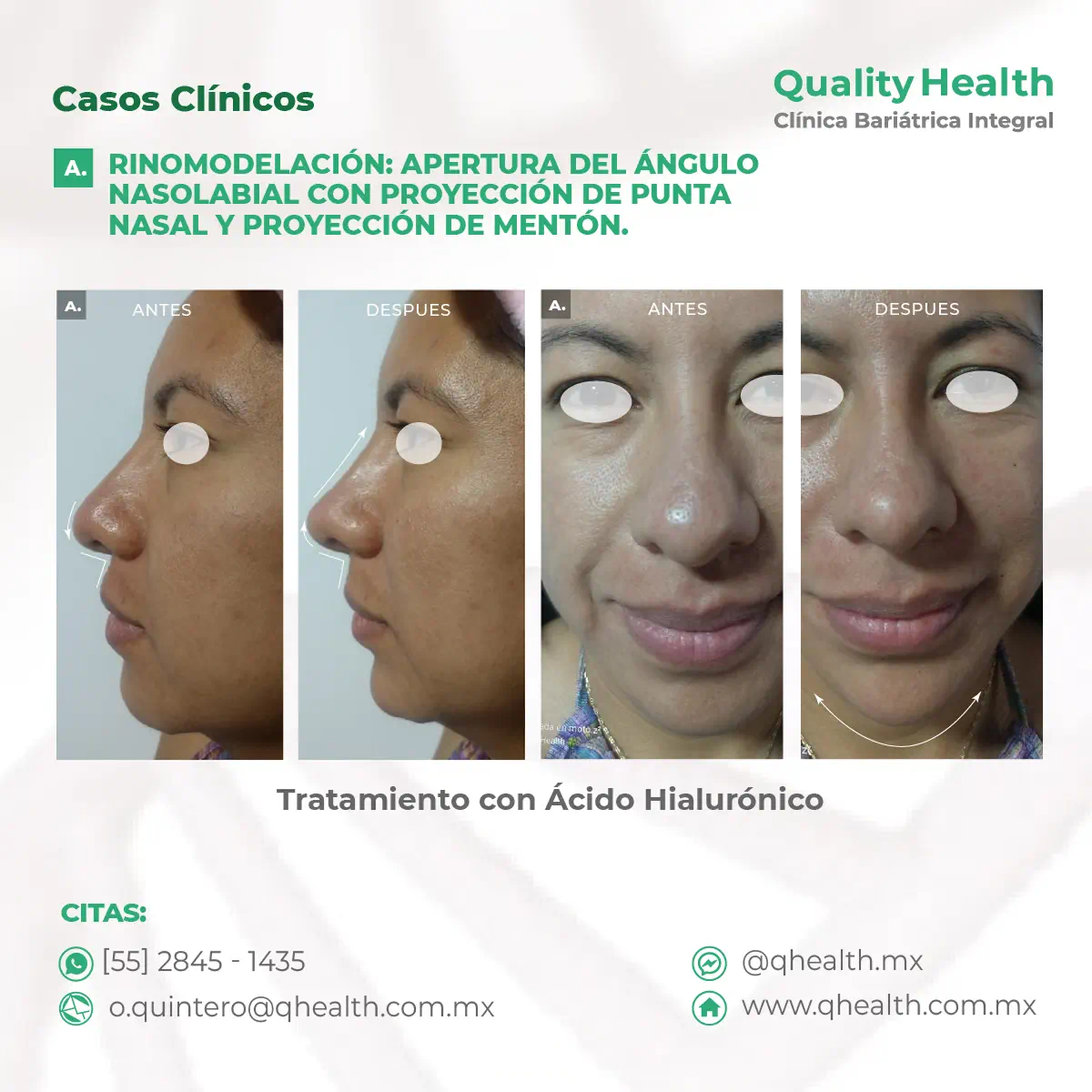 caso-clinico-rinomodelacion-y-poyeccion-de-menton-acido-hialuronico-02