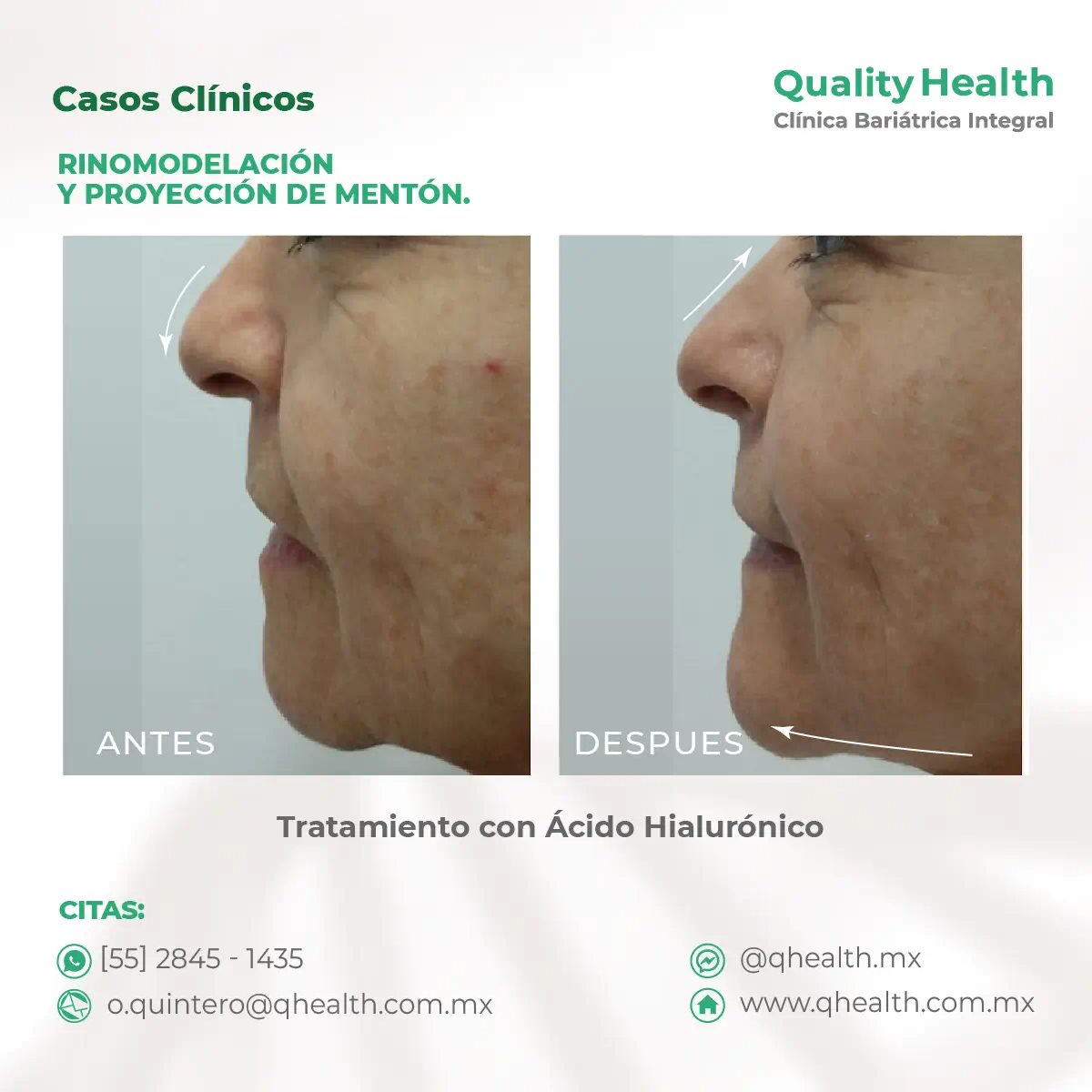 caso-clinico-rinomodelacion-y-poyeccion-de-menton-acido-hialuronico