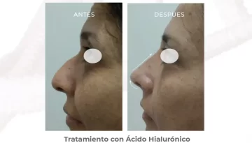 caso-clinico-rinomodelacion-y-poyeccion-de-punta-acido-hialuronico
