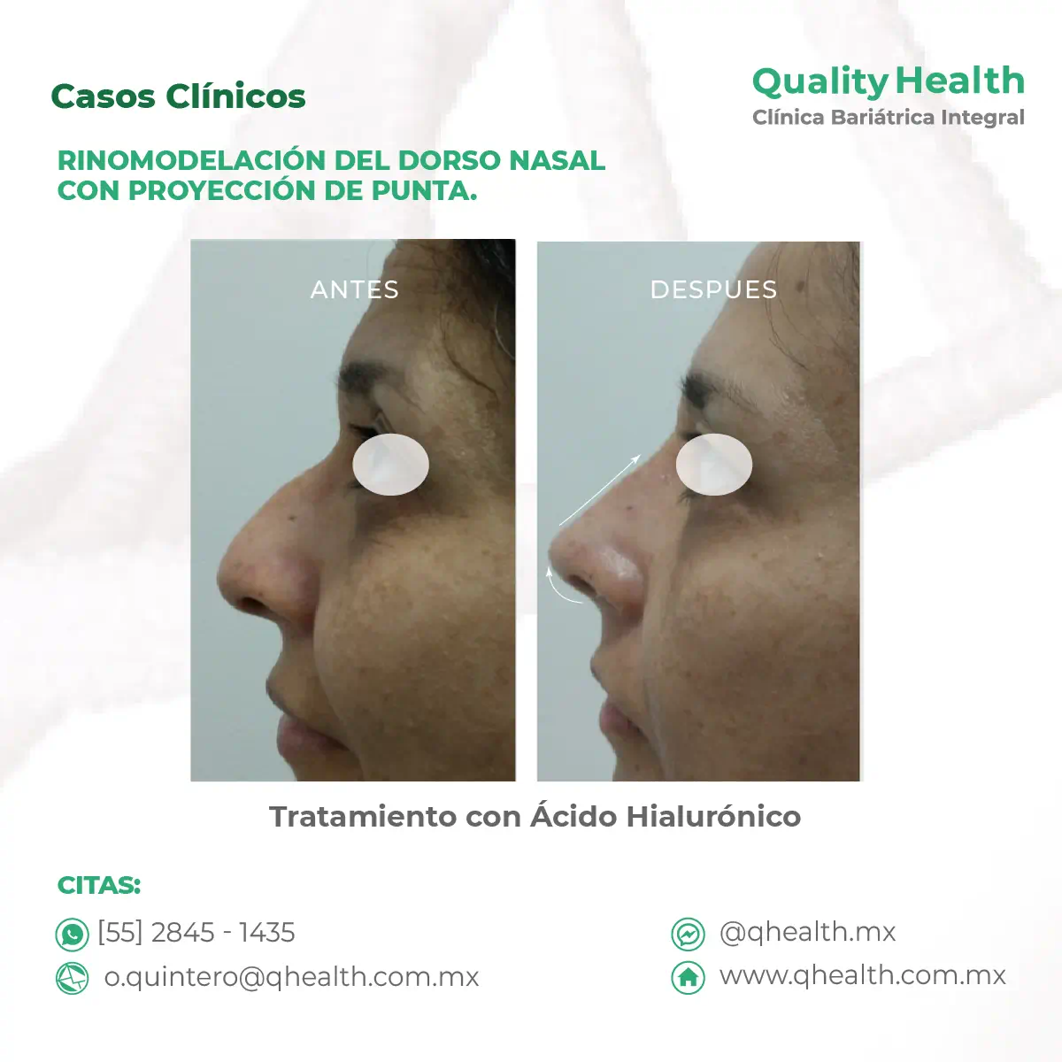 caso-clinico-rinomodelacion-y-poyeccion-de-punta-acido-hialuronico