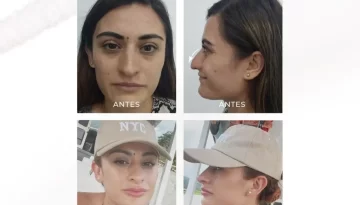 caso-clinico-rnimodelacion-diseño-de-labios-acidohialuronico